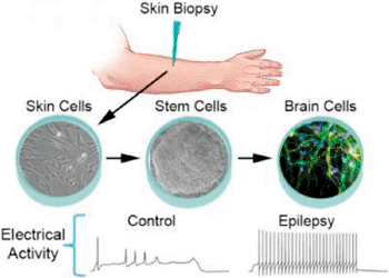 Image: This diagram shows the process by which scientists can take skin cells from patients with epilepsy, convert them to stem cells, and then create neurons (brain nerve cells) from them. The induced neurons contain the same genetic mutation(s) carried by the patients (Photo courtesy of the University of Michigan Medical School).